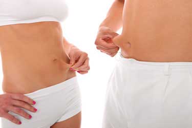 Abdominoplastik Hannover